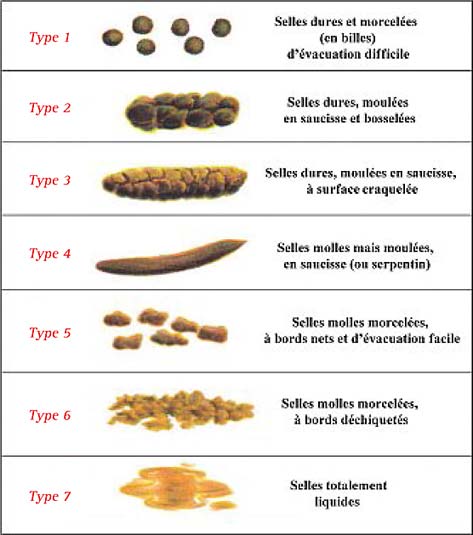 Tableau de classification de Rome IV ou les 7 types de selles pour diagnostiquer le SII.