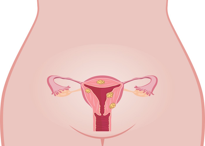 Dépistage du cancer du col de l'utérus : le test HPV
